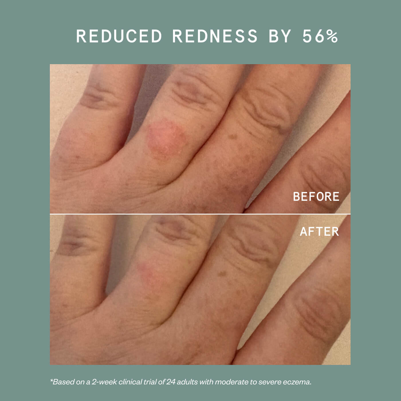ECZEMA PRECISION HYDROGEL
