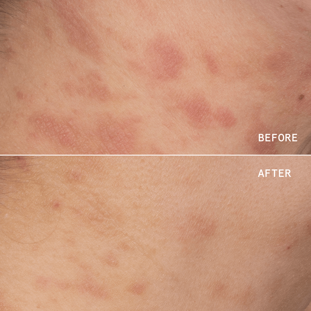 ECZEMA PRECISION KIT