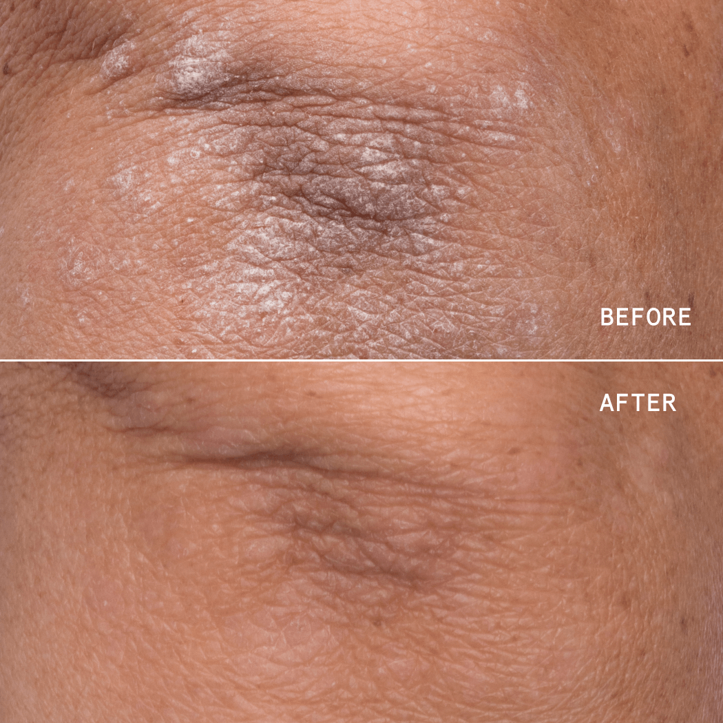 Eczema Relief + Repair Duo