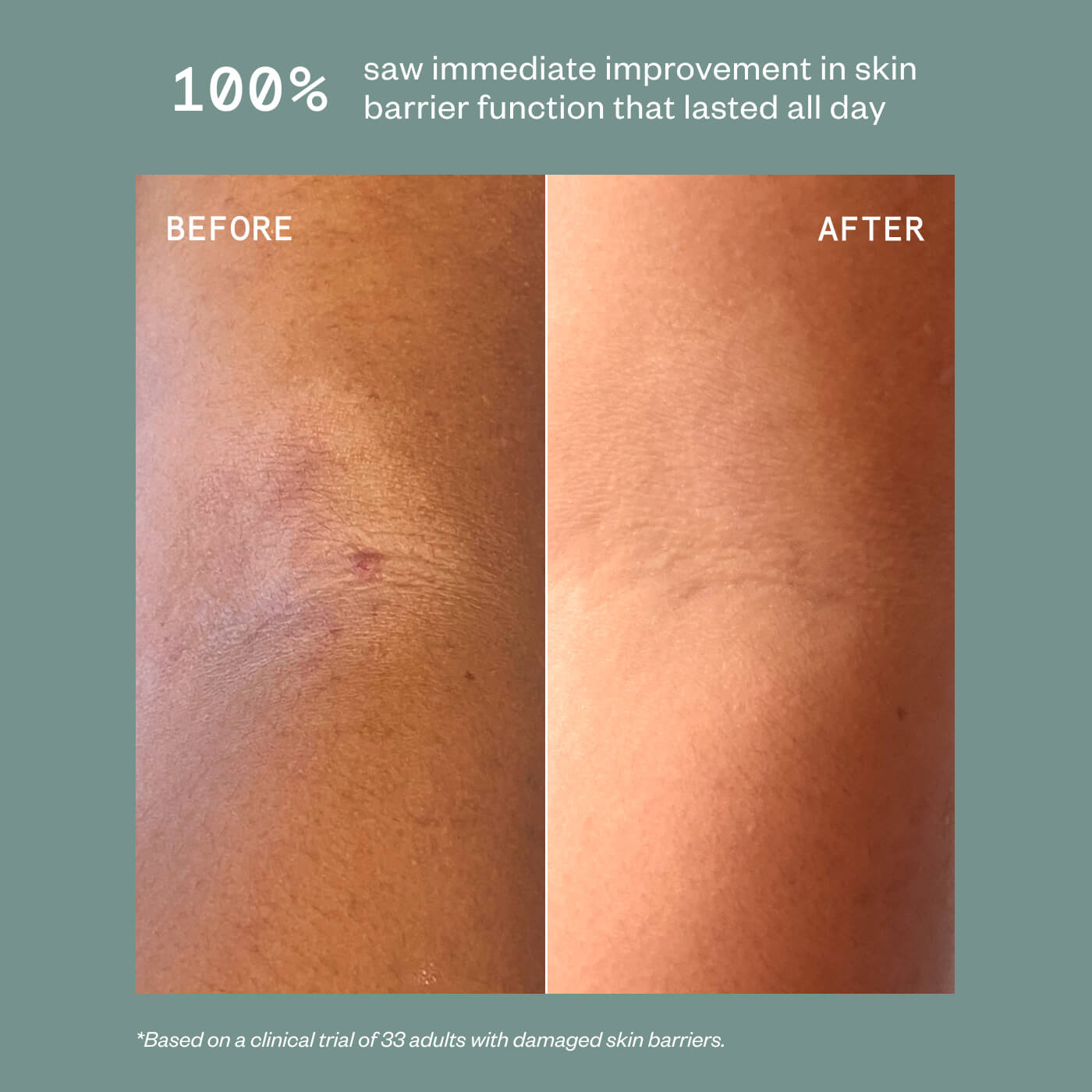 ECZEMA THERAPY CREAM