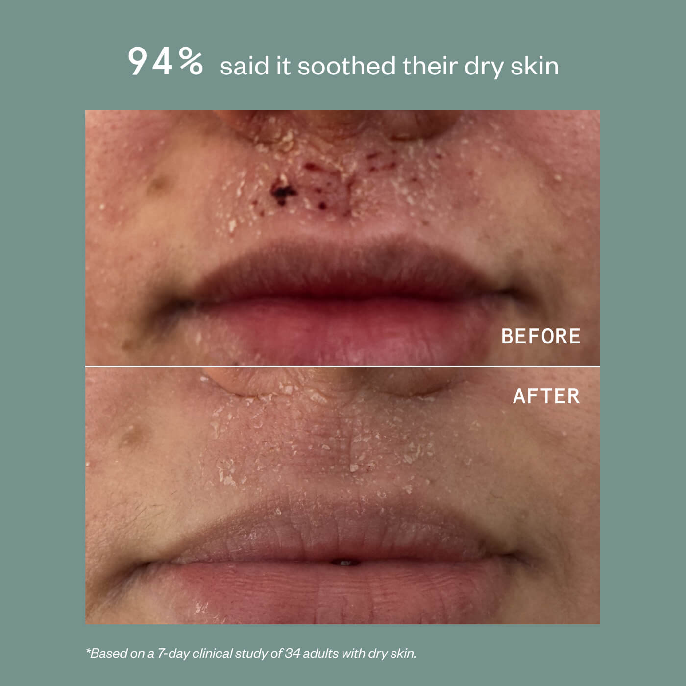 ECZEMA THERAPY CREAM