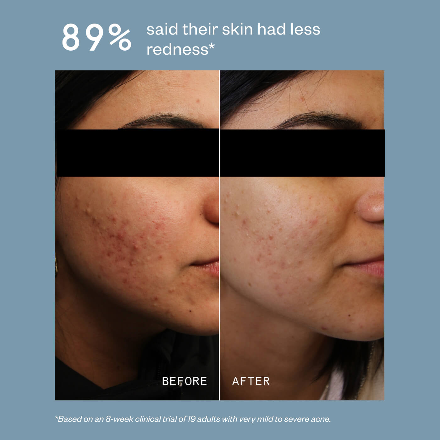 Acne Precision Serum