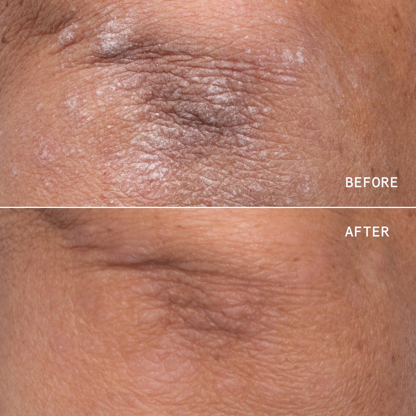 ECZEMA THERAPY CREAM