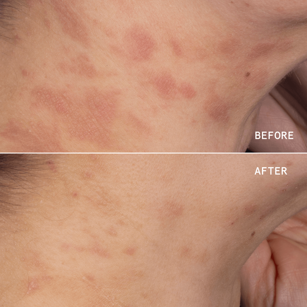 ECZEMA PRECISION HYDROGEL