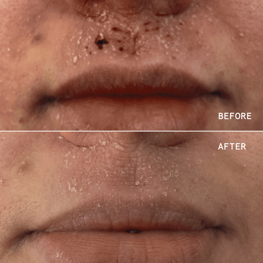 ECZEMA THERAPY CREAM
