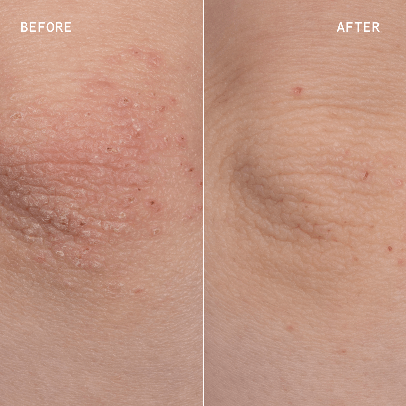 ECZEMA PRECISION HYDROGEL