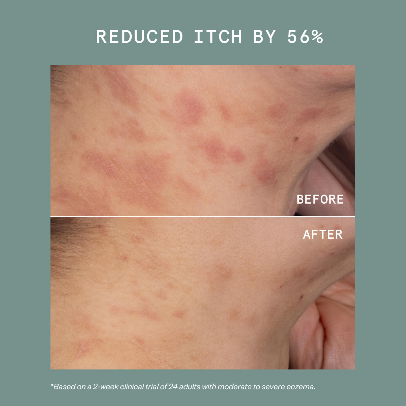 ECZEMA PRECISION HYDROGEL