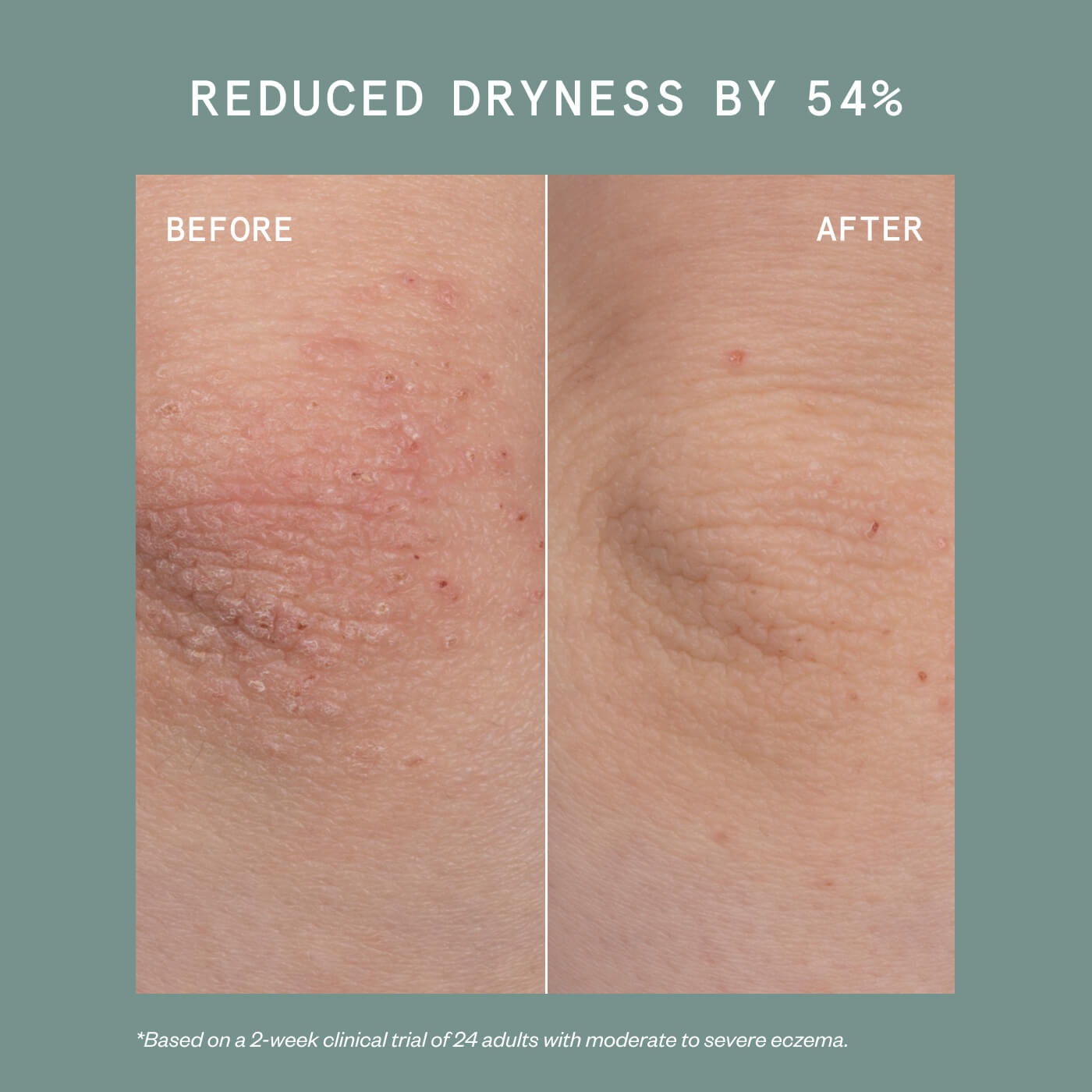ECZEMA PRECISION HYDROGEL