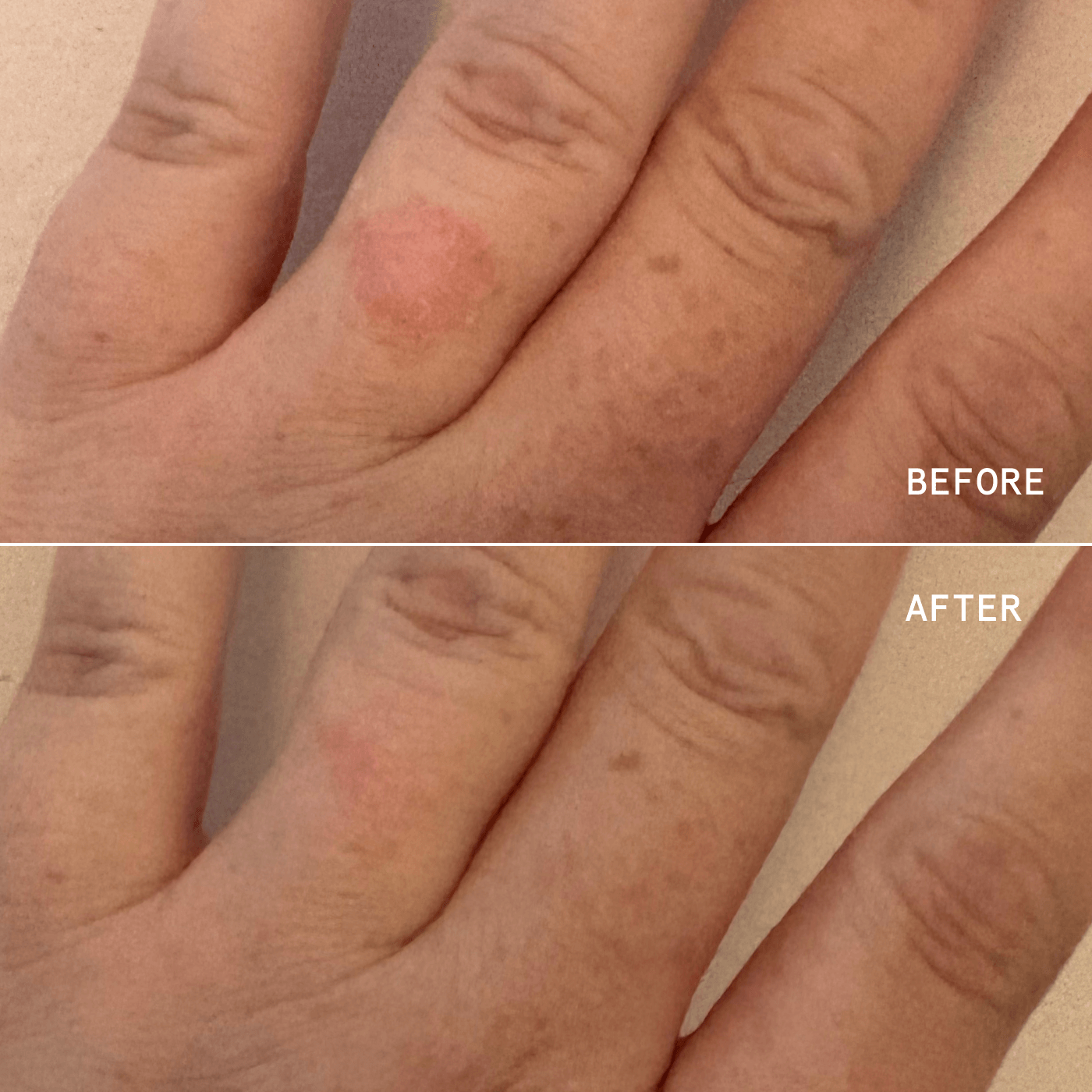 ECZEMA PRECISION HYDROGEL
