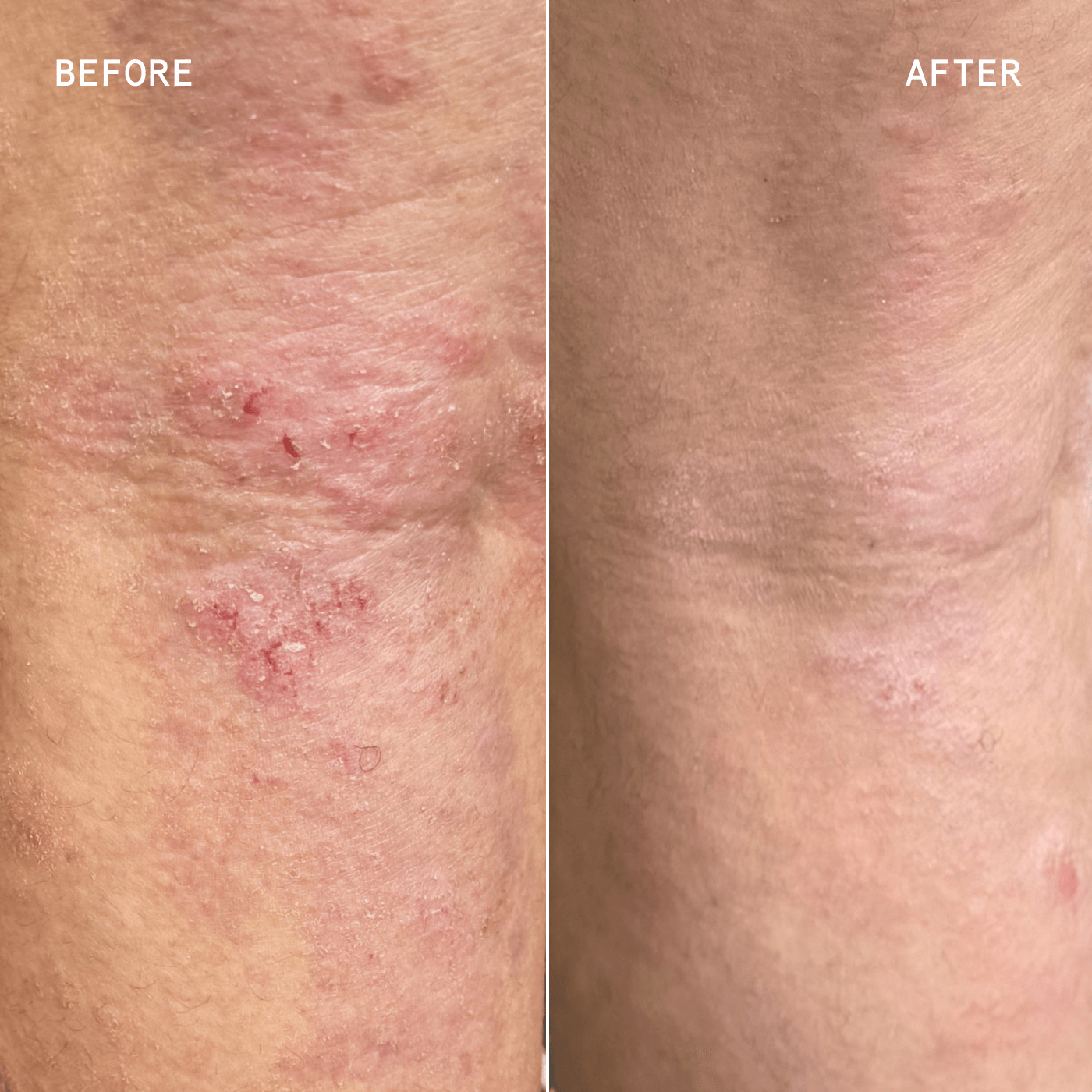 PRECISION HEALING SPRAY